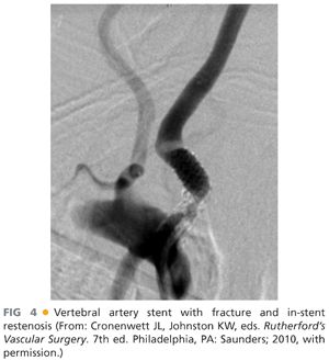 Vertebral Transposition Techniques and Stenting | Thoracic Key