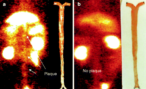 Oxidized Low-Density Lipoprotein and Atherogenesis | Thoracic Key