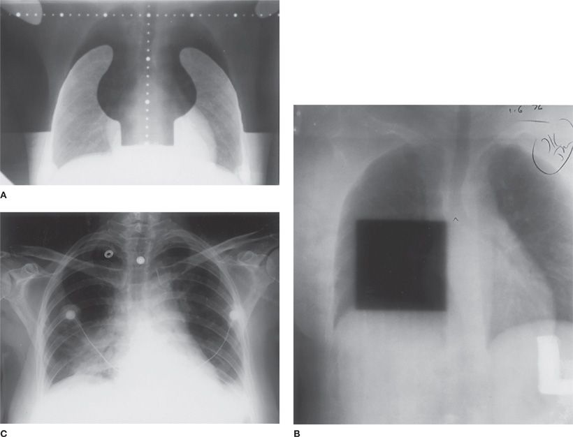 Radiation Pneumonitis Thoracic Key
