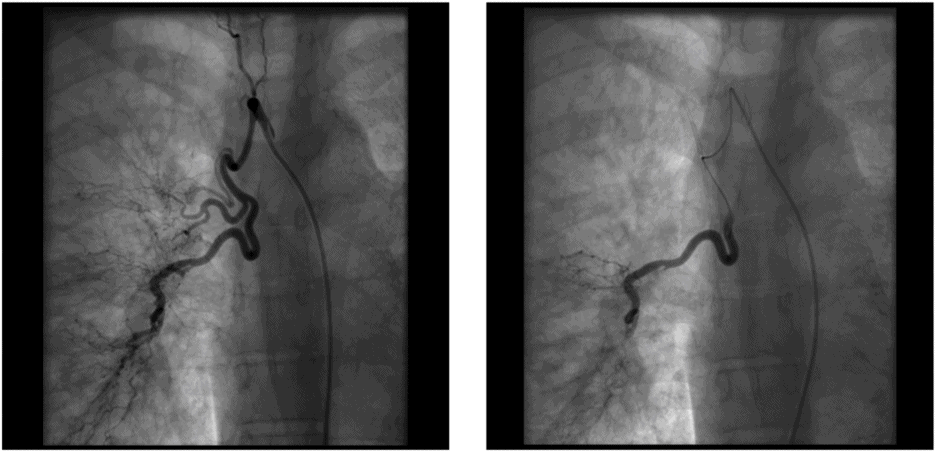 Treatment of haemoptysis | Thoracic Key