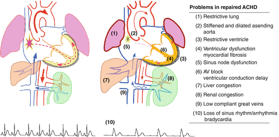 Heart Failure in Adults with Congenital Heart Disease | Thoracic Key