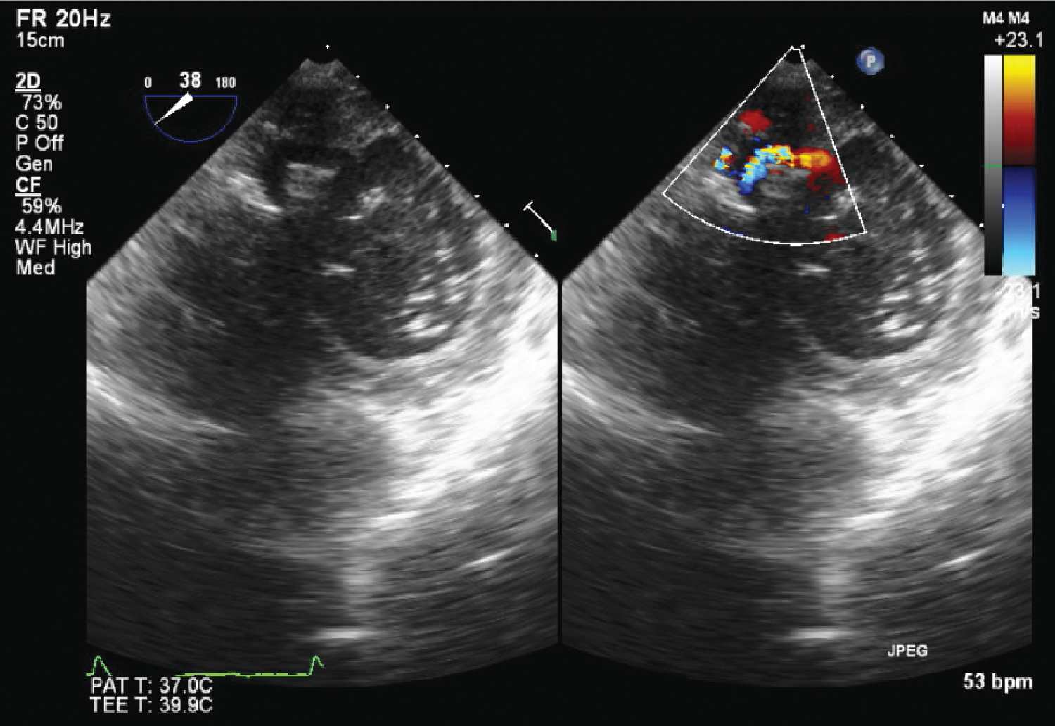 Echocardiography in the Evaluation and Management of the Patient with Known  or Suspected Coronary Artery Disease | Thoracic Key