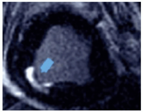 Cardiovascular Magnetic Resonance Imaging | Thoracic Key