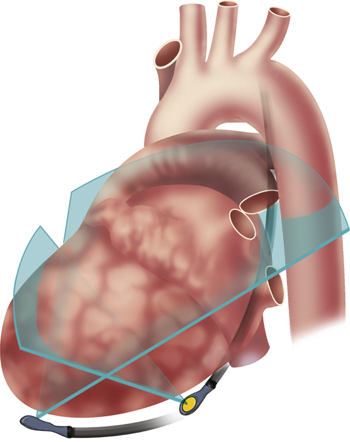 Transesophageal Echocardiography | Thoracic Key