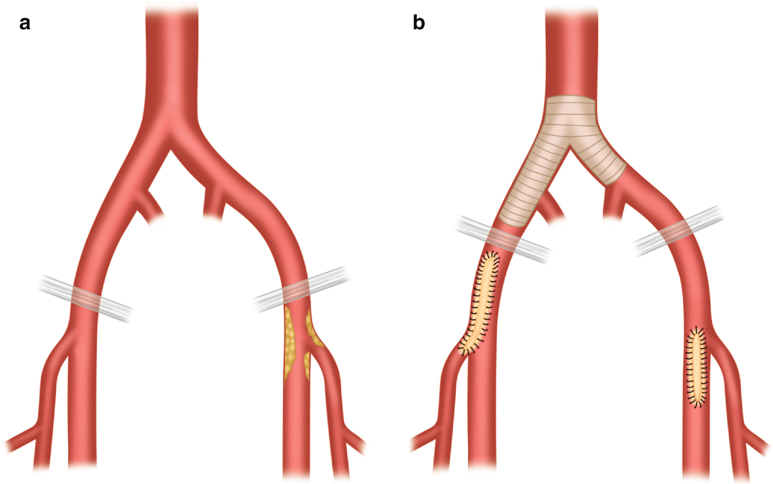 Aortoiliac Occlusive Disease: Endovascular Management – VJIPHE