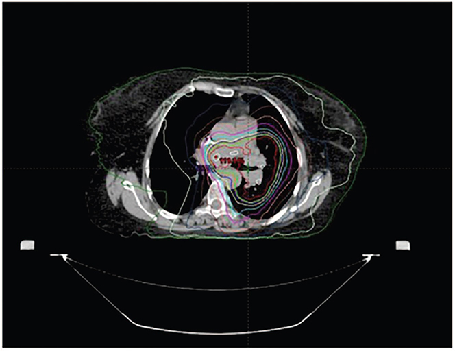 Small Cell Lung Cancer Treatment: Locally Advanced | Thoracic Key
