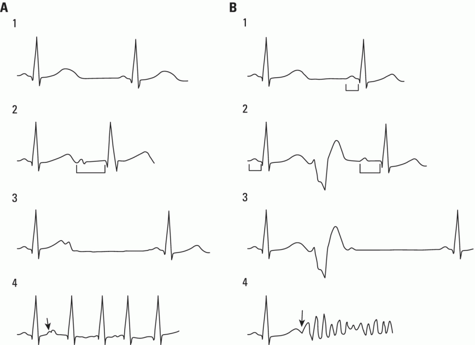 Schematic illustration of (A-1 and B-1) Normal AV conduction. (A-2) Premature atrial complex (PAC) falls in the RRP of the AV junction and the next sinus P wave shows a long PR interval. (B-2) There is an interpolated premature ventricular complex (PVC) and the next P wave shows a longer PR interval. (A-3) PAC falls in the ARP of the AV junction and is not conducted. (B-3) Due to concealed retrograde conduction in the AV junction of a PVC, the next P wave is blocked. (A-4) When a PAC falls into the atrial VP, it may trigger an atrial fibrillation. (B-4) When a PVC falls in the ventricular vulnerable period, especially in acute ischemia, a ventricular fibrillation may be triggered.