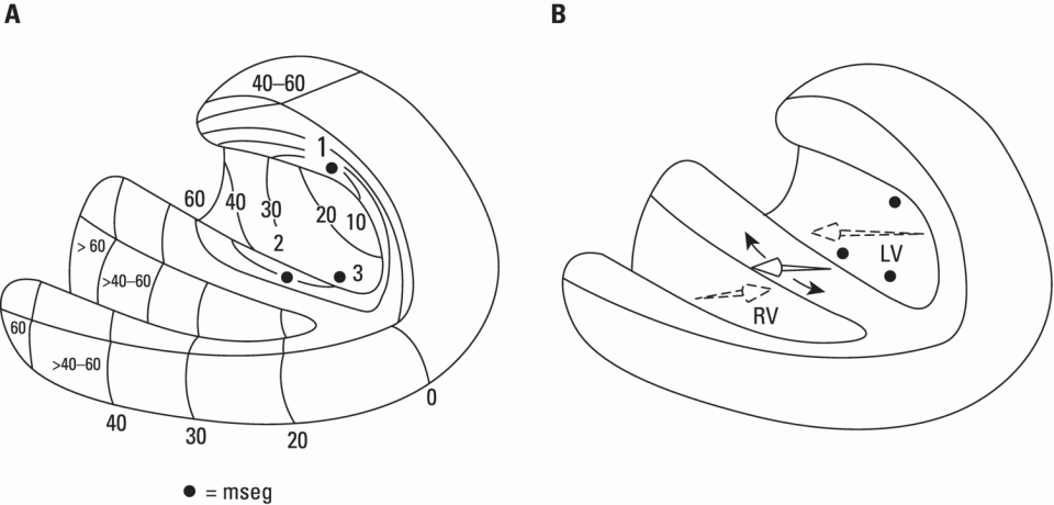 Schematic illustration of (A) The three approximate initiation points of ventricular depolarization (closed circles) (1, 2, 3) forming the isochronic lines of the depolarization sequence.