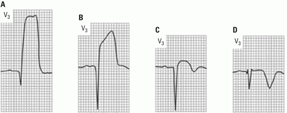 Schematic illustration of acute infarction of anteroseptal zone with ST segment elevation in the pre-fibrinolytic era. Evolutionary phases: (A) at 30 minutes, (B) 1 day later, (C) 1 week later, and (D) 2 weeks later.