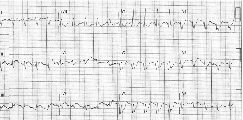 Schematic illustration of the recurrent acute coronary syndrome (ACS). A 75-year-old man with old anterior myocardial infarction complicated by right bundle branch block (RBBB), who presented with heart attack.