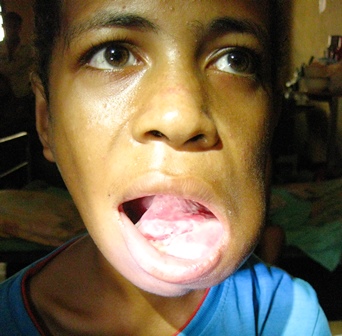 This swelling arose from a baby tooth that didn't fall out by itself. Fueled by TB infection, it grew until it covered this 12 year old boy’s teeth so he could no longer eat. It took him 4 days to travel to a doctor