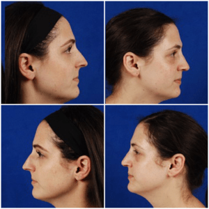 Septorhinoplasty Before and After