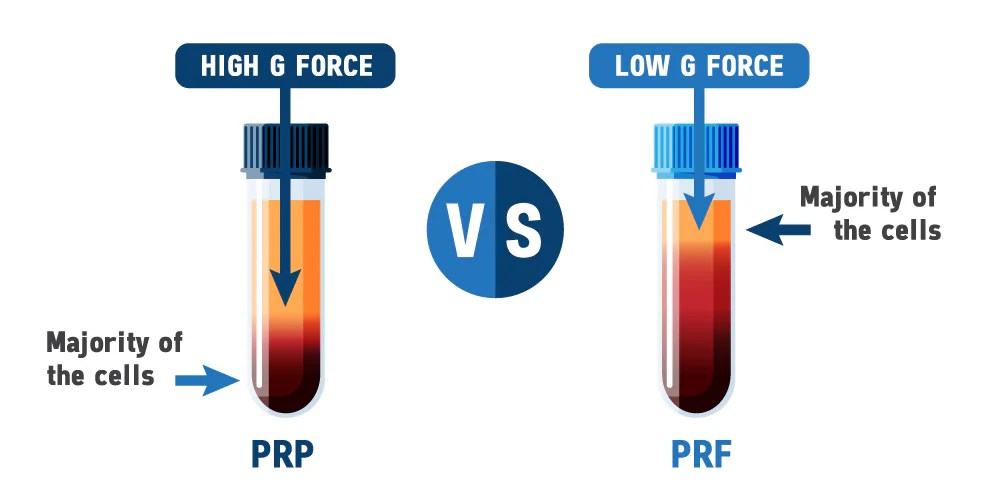 Unveiling The Difference Prp Vs Prf In Regenerative Medicine T Lab