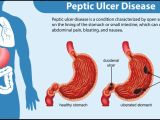 Gastric Ulcer Vs Duodenal Ulcer Stomach In Situ