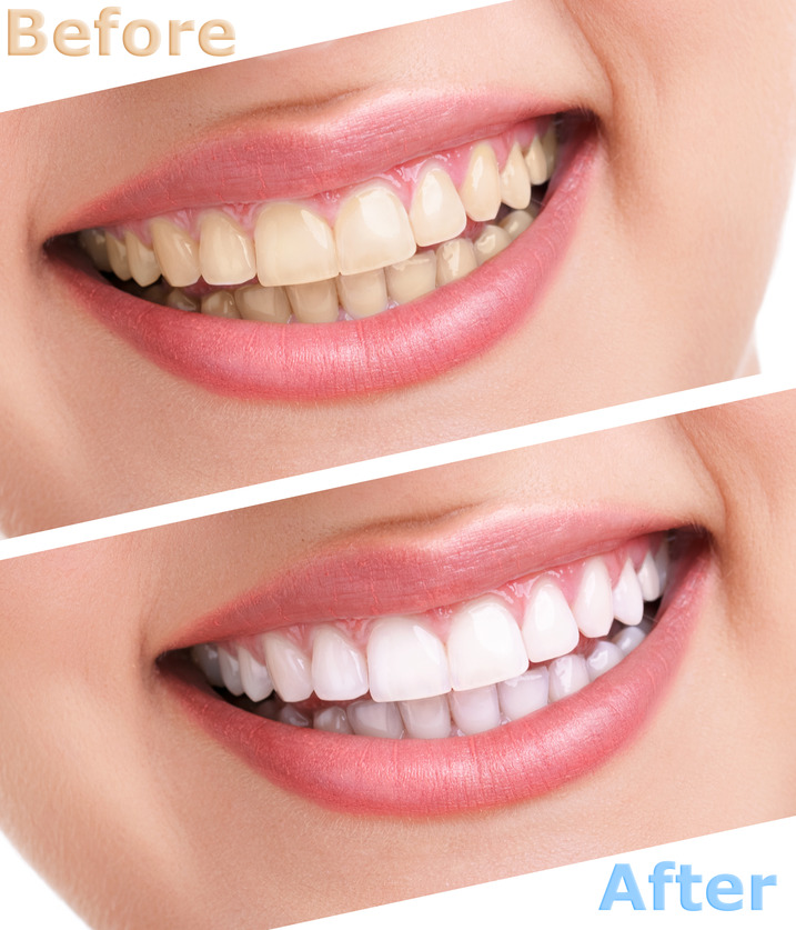 Teeth Whitening : : Trafalgar Dental Care : : www.trafalgardentalcare ...