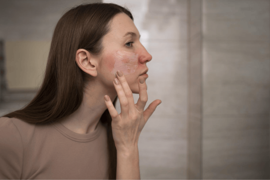 A woman with a red, irritated cheek applies a soothing cream to her face.