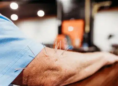 Dry Needling in East Tennessee Homepage
