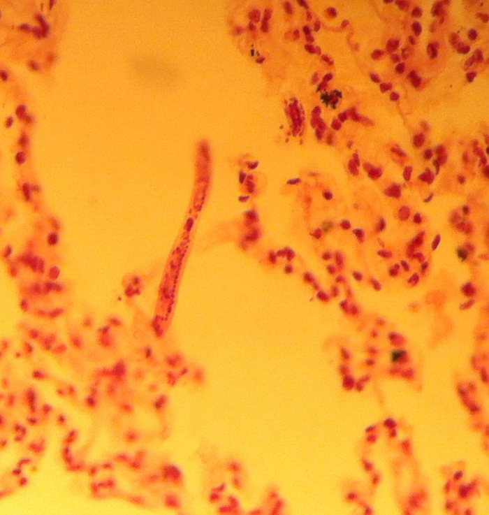 ascaris larva lung