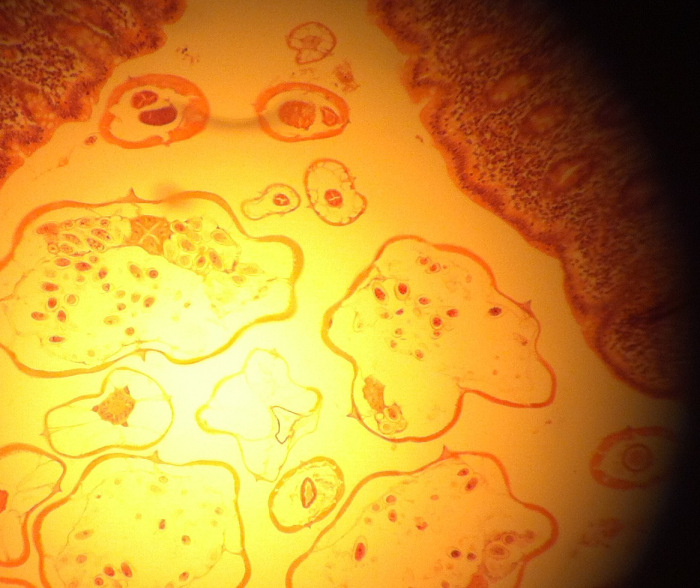 enterobius in appendix