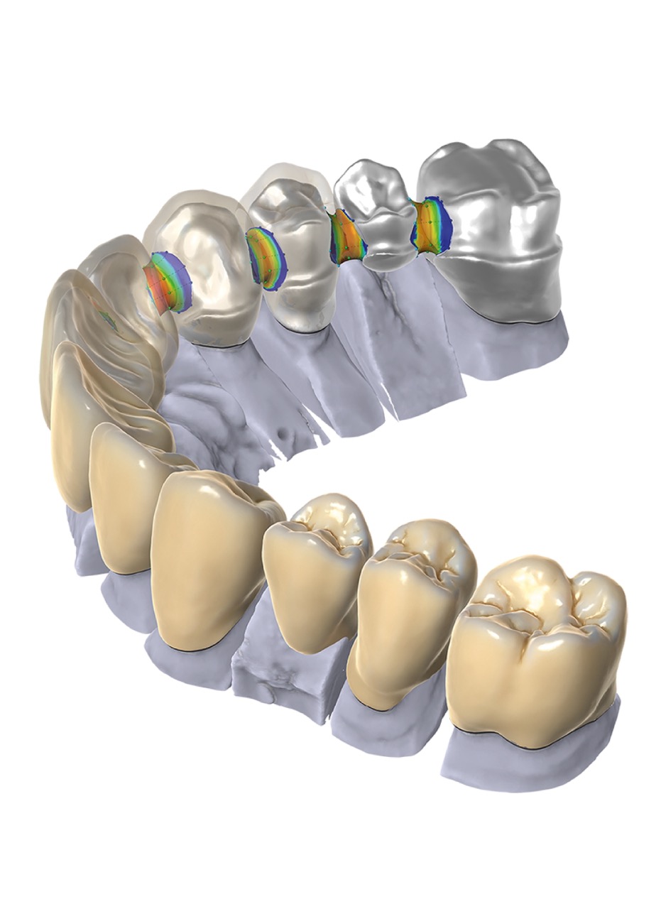 Digital rendering of dental crowns and bridges showcasing advanced dental restoration techniques.
