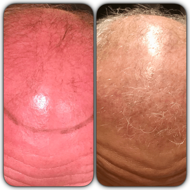 voor de operatie en 19 nov 2 maanden na de operatie