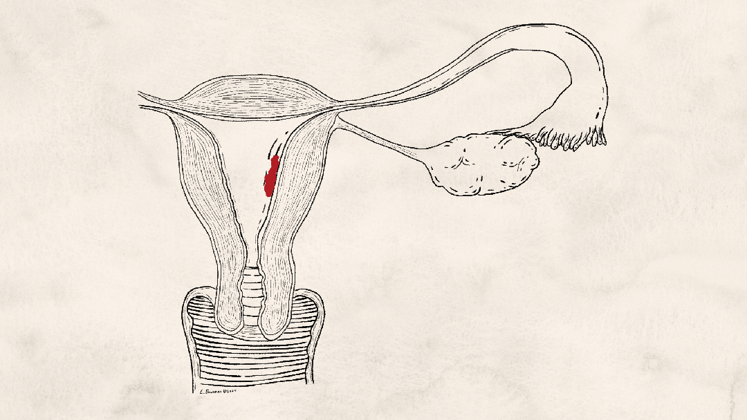 This gif depicts how menstrual blood can travel back up the fallopian tube to form an endometrioma