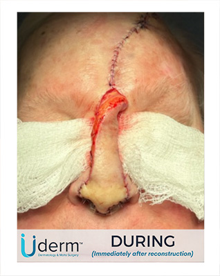 moh’s surgery after the procedure