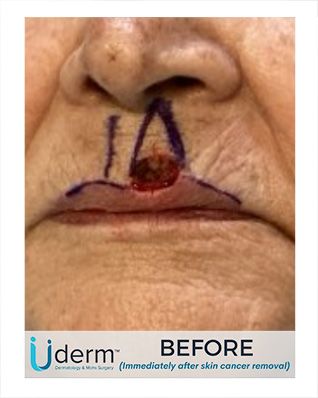 crater in upper lip left by skin cancer removal