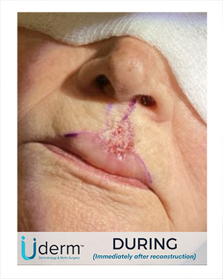 moh’s surgery after the procedure