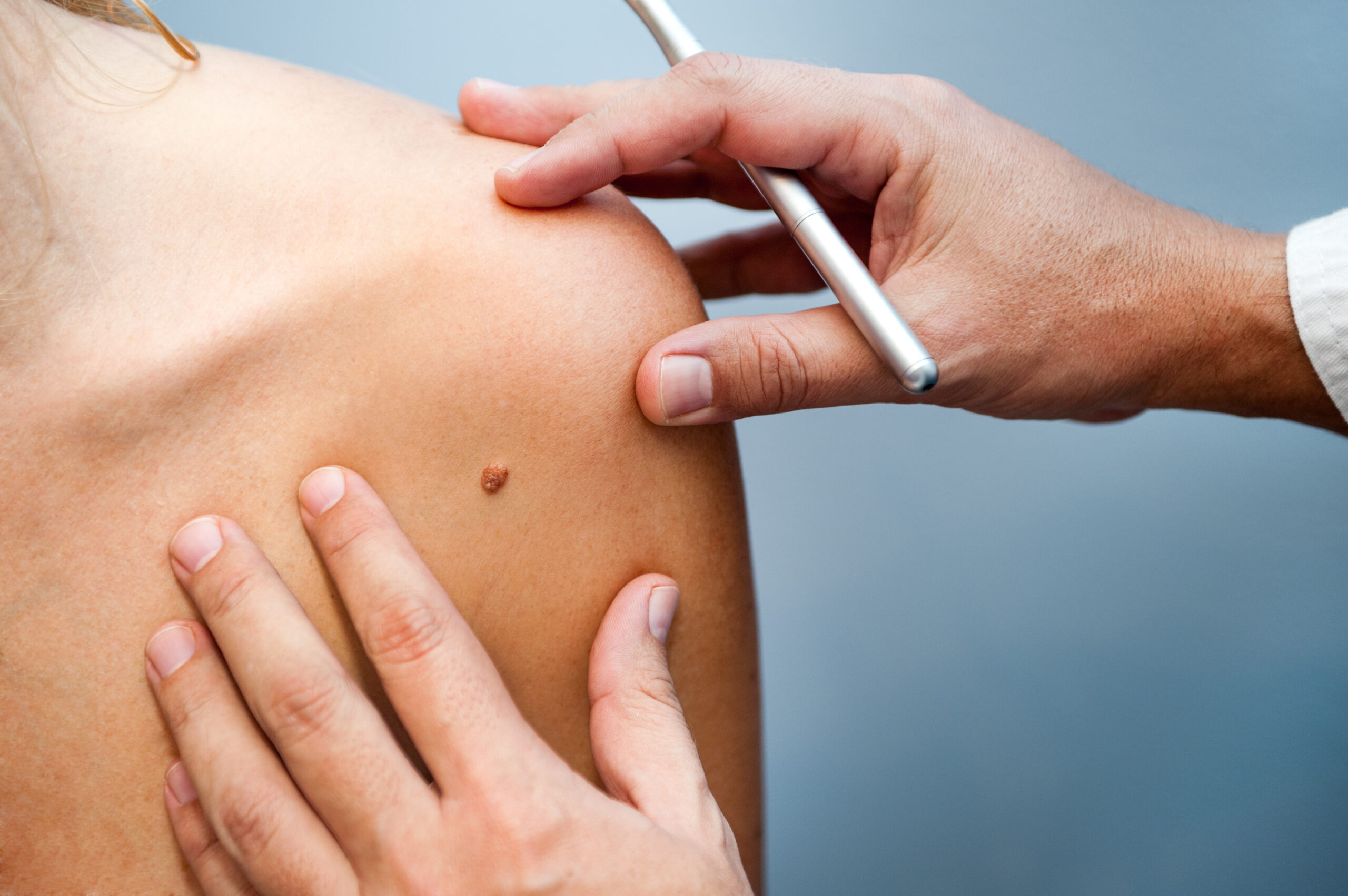 Mole on skin