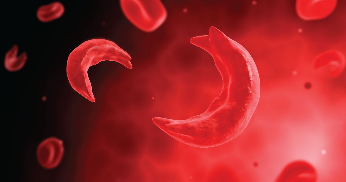 Tech Speeds Up Cure for Sickle Cell Disease as London Leads Global Trials
