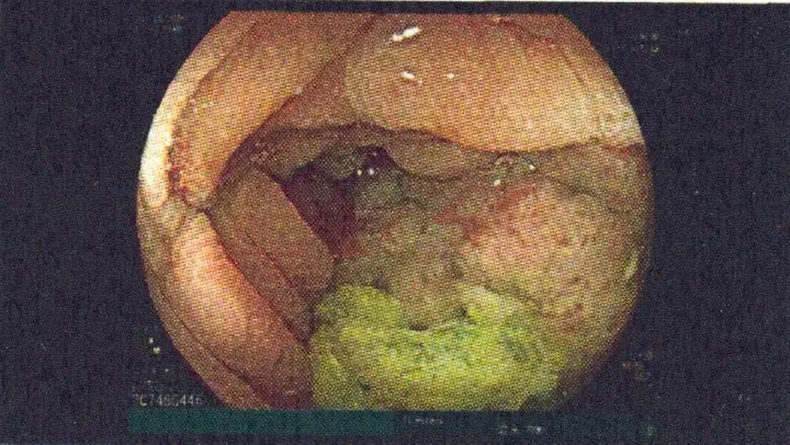 Benign granuloma in colon