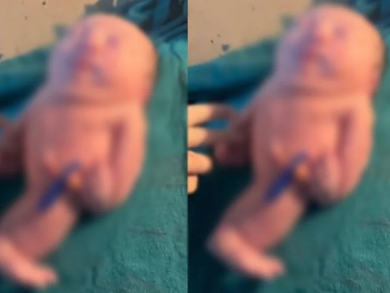 मछली के अकार का बच्चा : जन्म के बाद फटी रह गईं स्टाफ की आंखें
