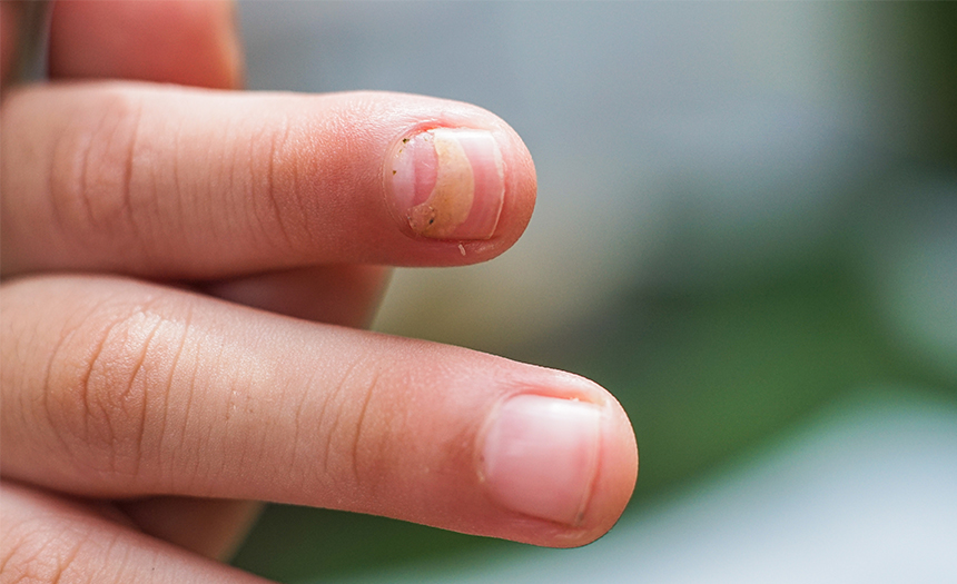 La apariencia de tus uñas puede dar indicios de una enfermedad grave