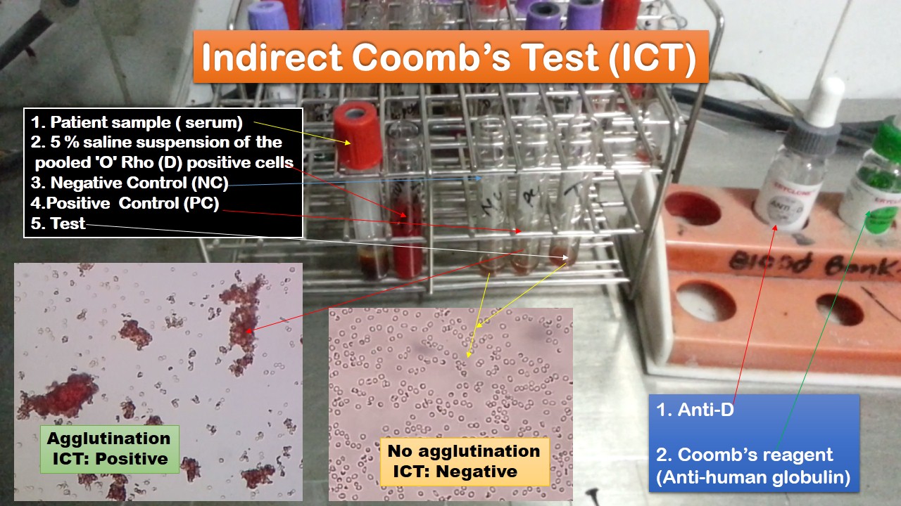 Featured conditions what it is, how it's done, how to prepare, risks and results. Indirect Coomb Test Ict Introduction Principle Procedure Result Interpr