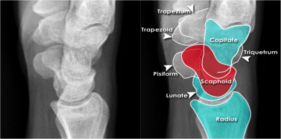 Tfcc Hand . Wrist Trauma Radiographic Evaluation - Hand - Orthobullets