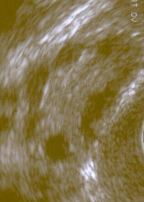 Polycystic Ovary by Sonography. Polycystic Ovary by Sonography.
