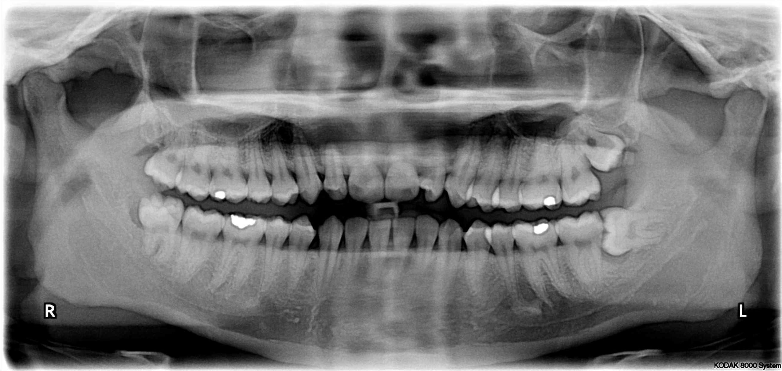 The Best 20 How Many Teeth Does A Human Have Including