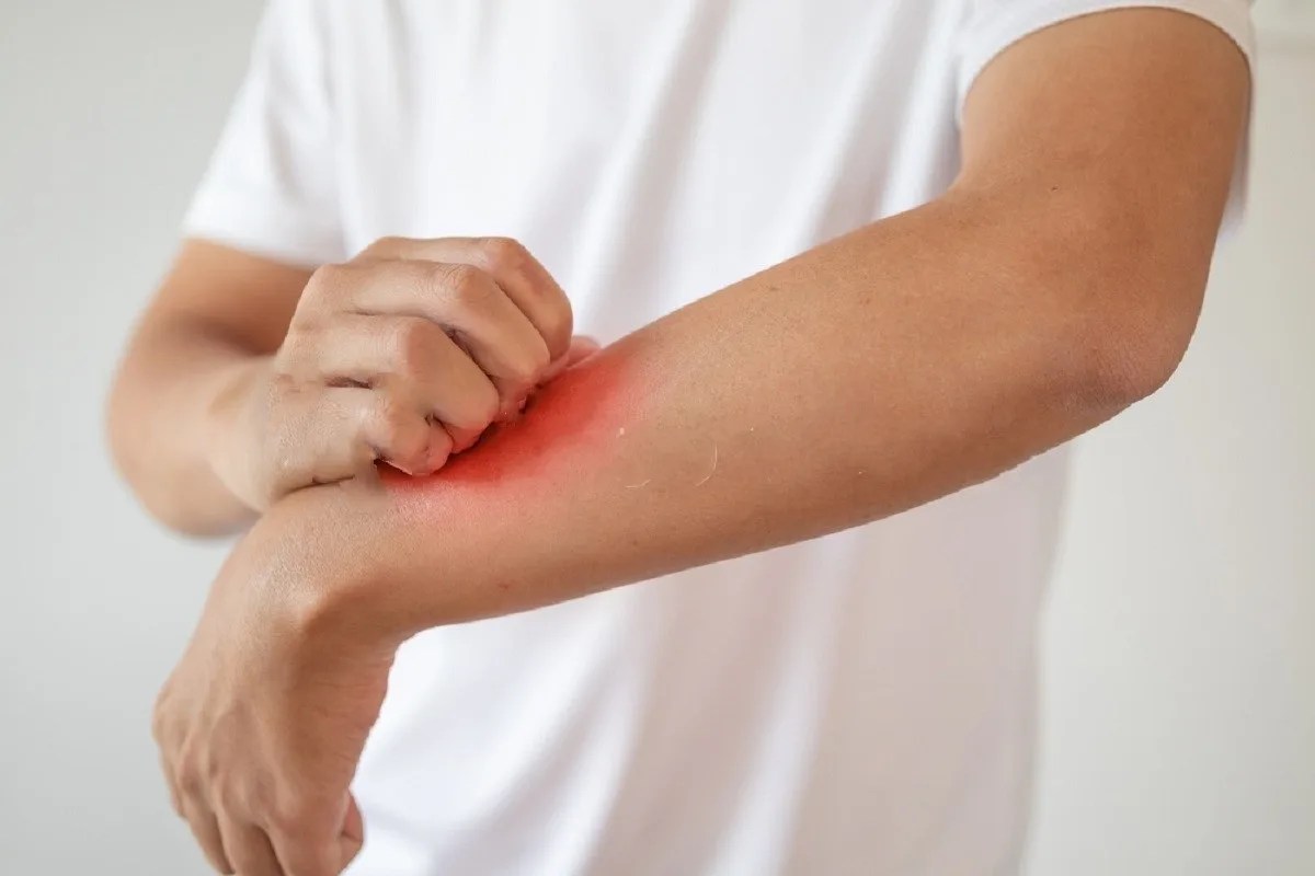 Natural Solutions to Overcome Persistent Eczema