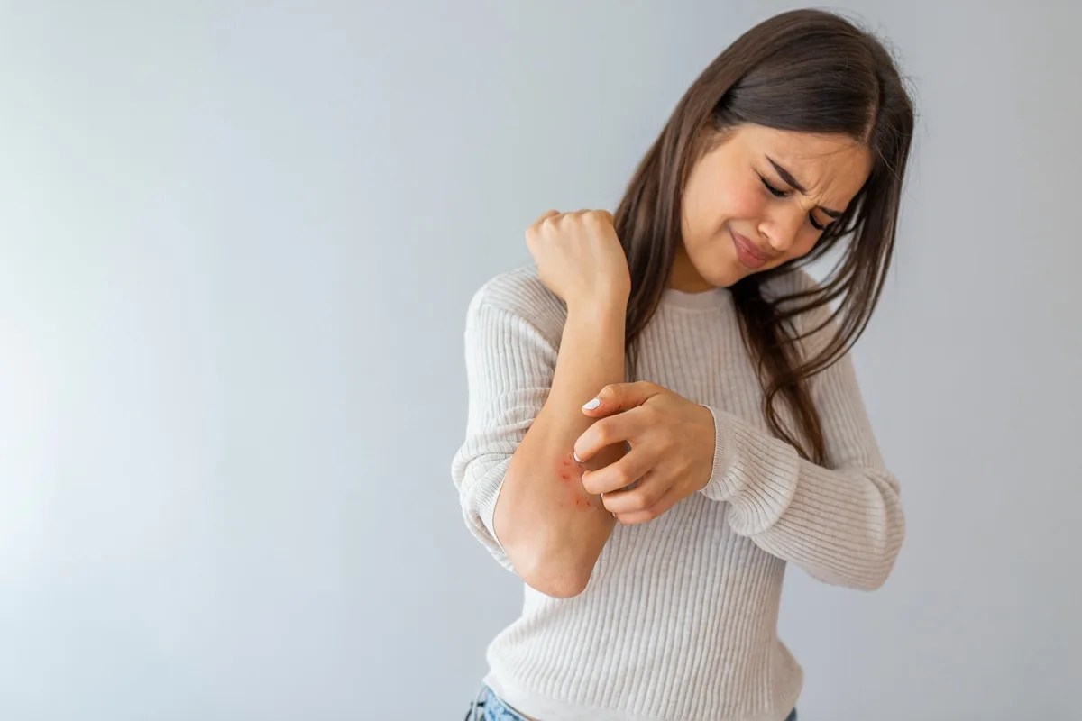 Natural Solutions to Overcome Persistent Eczema