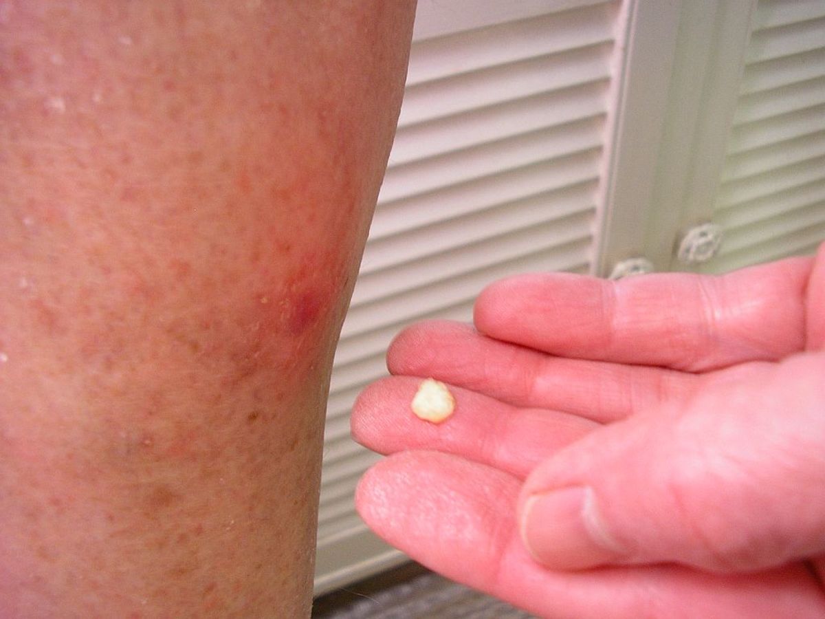 Food grade hydrogen peroxide treatment removes solar keratosis