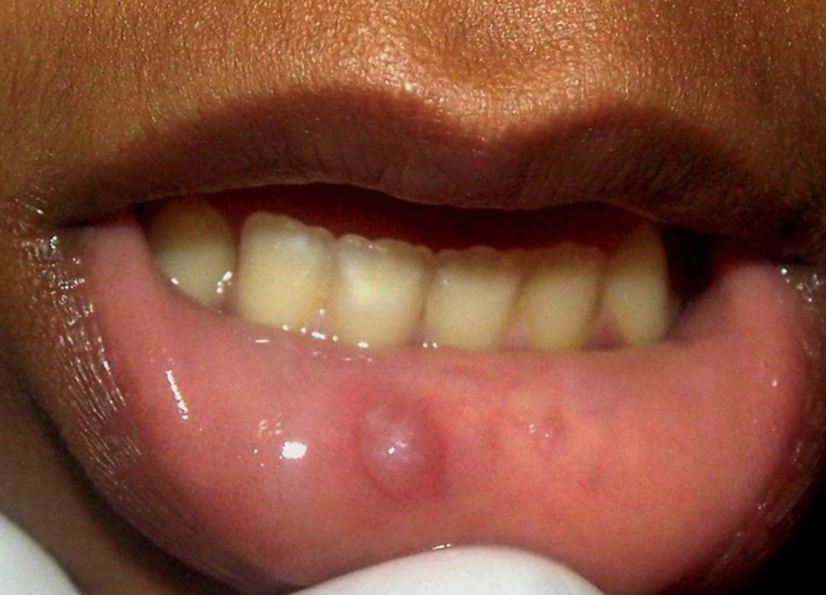 31+ Nice Inner Bottom Lip Piercing - Vertical lip piercing! - YouTube - The piercing can rub the front part of your bottom row of teeth.