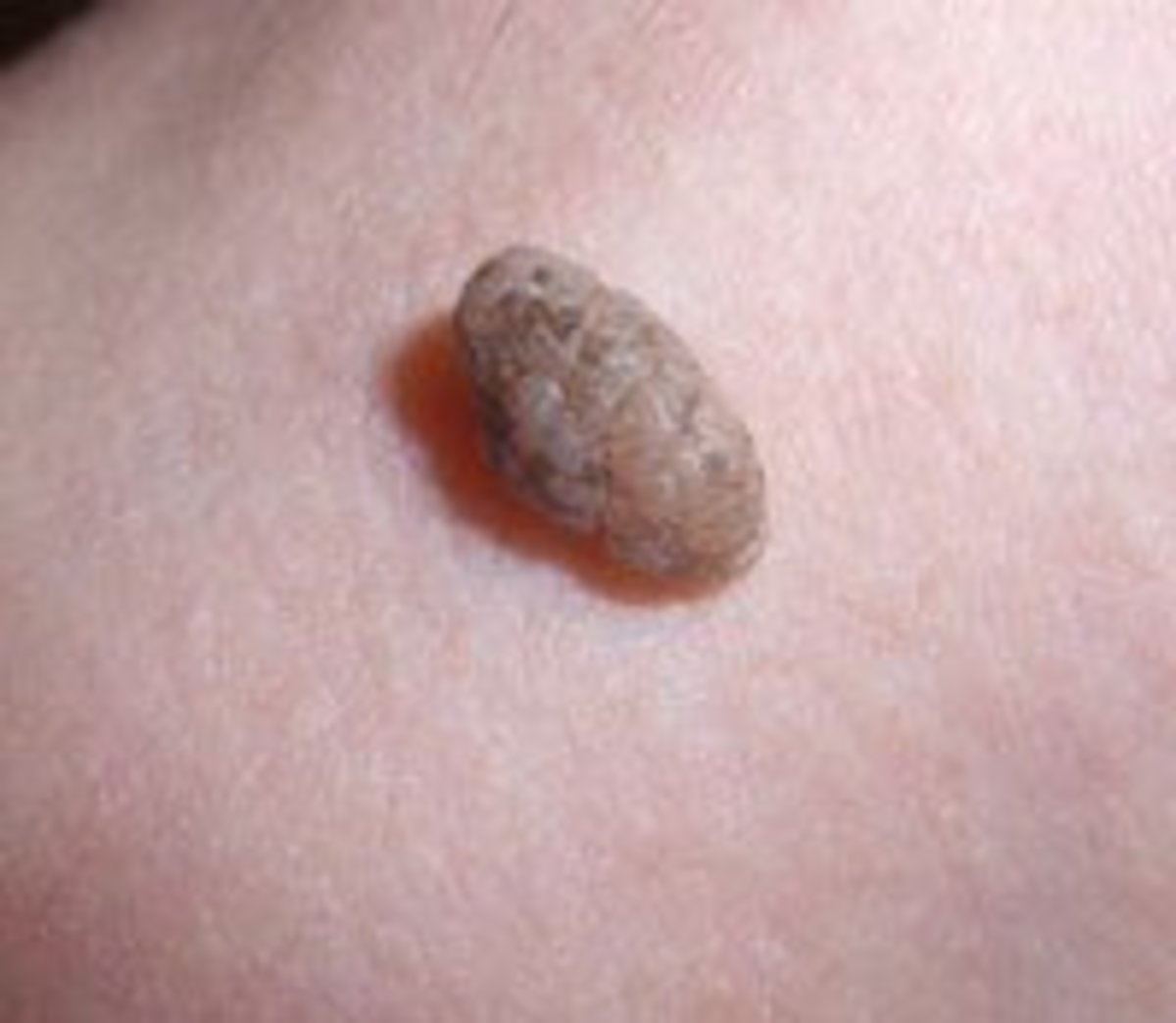 Two new studies find an association between breast cancer and moles. Skin Tags-Should You Be Concerned? | HubPages