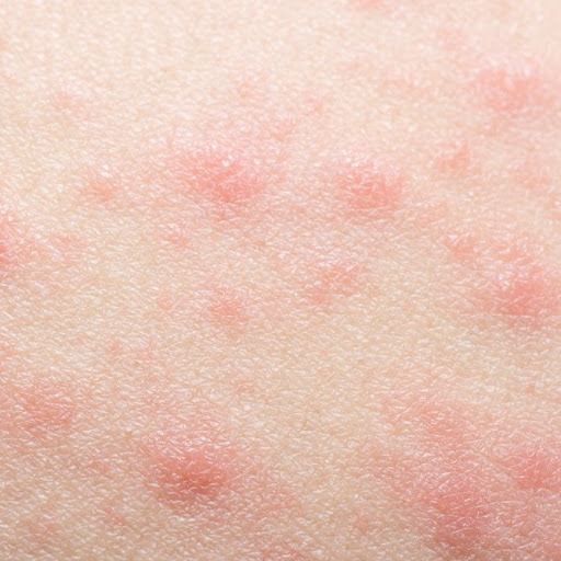 Understanding Contact Dermatitis Utah County