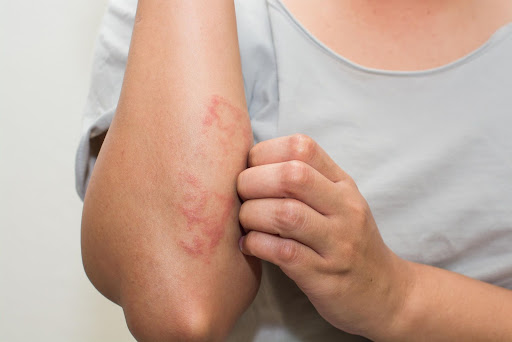 Dermatitis, itchy skin