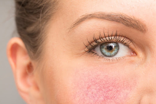 Facial redness, rosacea