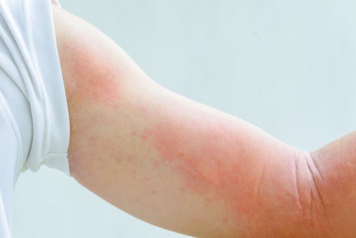 hives