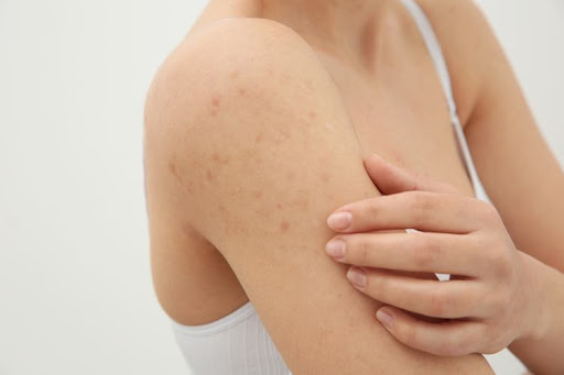 Keratosis Pilaris