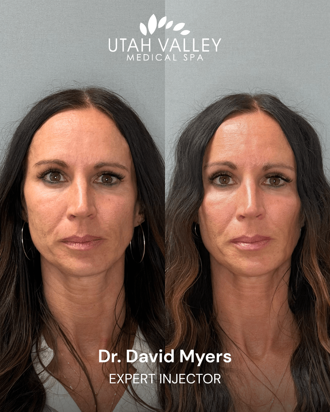 Dermal Fillers Before and After 1