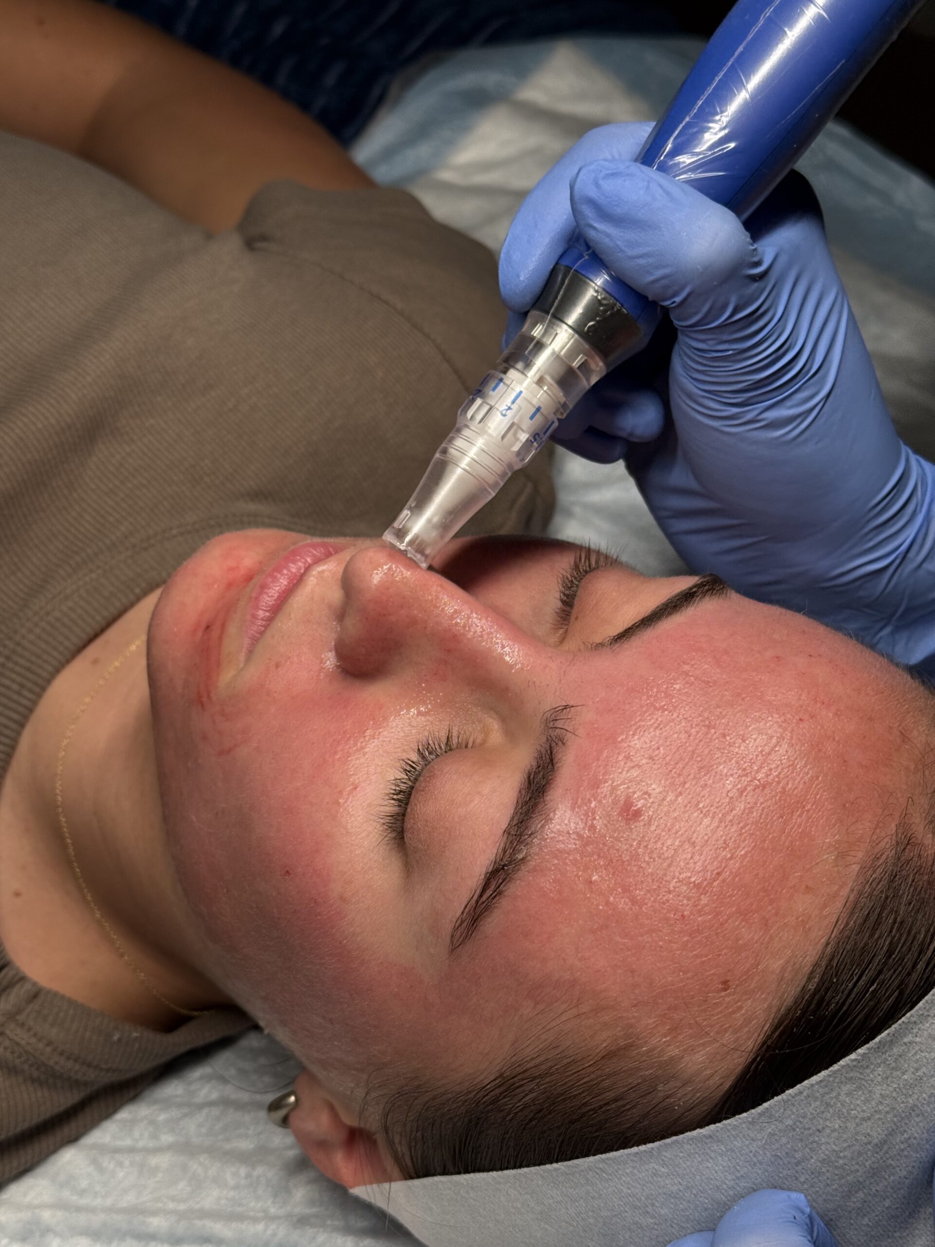 Microneedling at Utah Valley Medical Spa